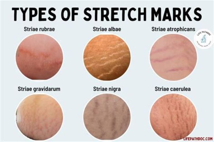 Stretch marks fupa getting the d lyrics